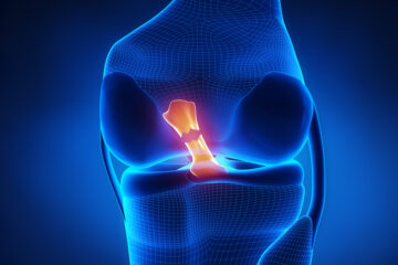 ACL Rehabilitation