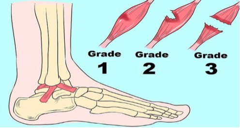 ankle-sprain physio