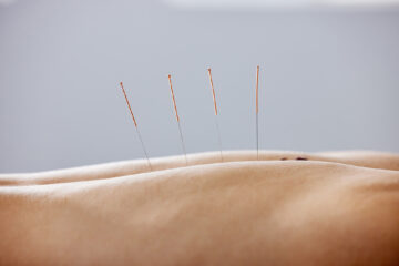 Acupuncture & Dry Needling